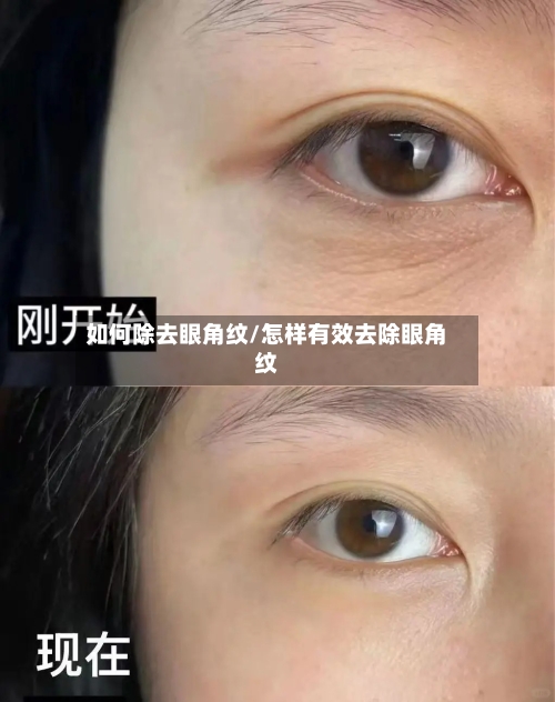 如何除去眼角纹/怎样有效去除眼角纹-第2张图片