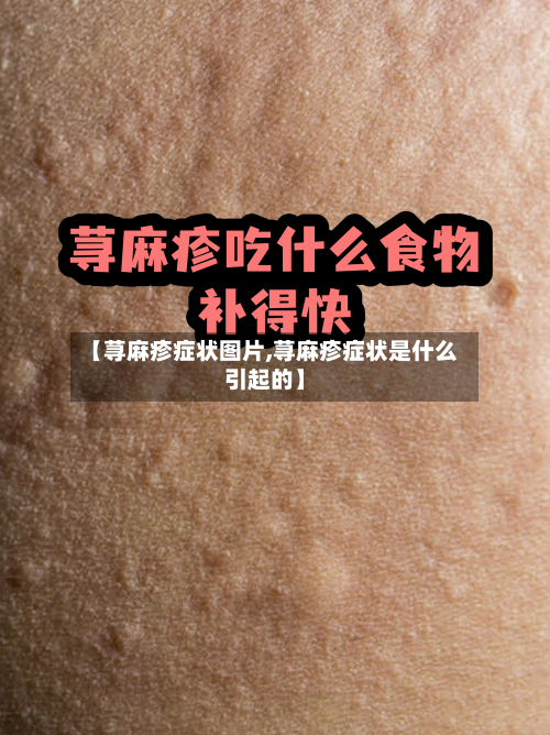 【荨麻疹症状图片,荨麻疹症状是什么引起的】